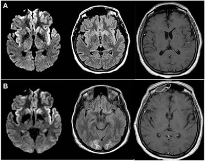 Case Report: <mark class="highlighted">Yellow Fever</mark> Vaccine-Associated Neurotropic Disease and Associated MRI, EEG, and CSF Findings